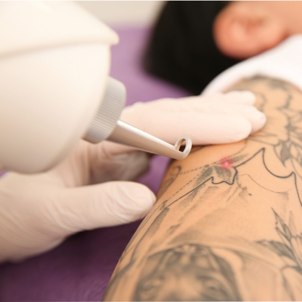 BPES LASER TATTOO REMOVAL